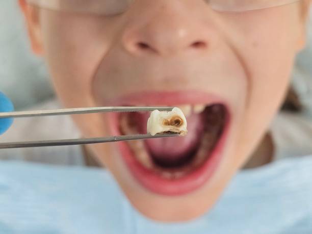 Best Emergency Wisdom Teeth Removal in Wamego, KS